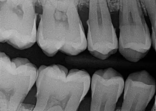 How to Take PERFECT Dental X-rays! 7 Tips and Tricks