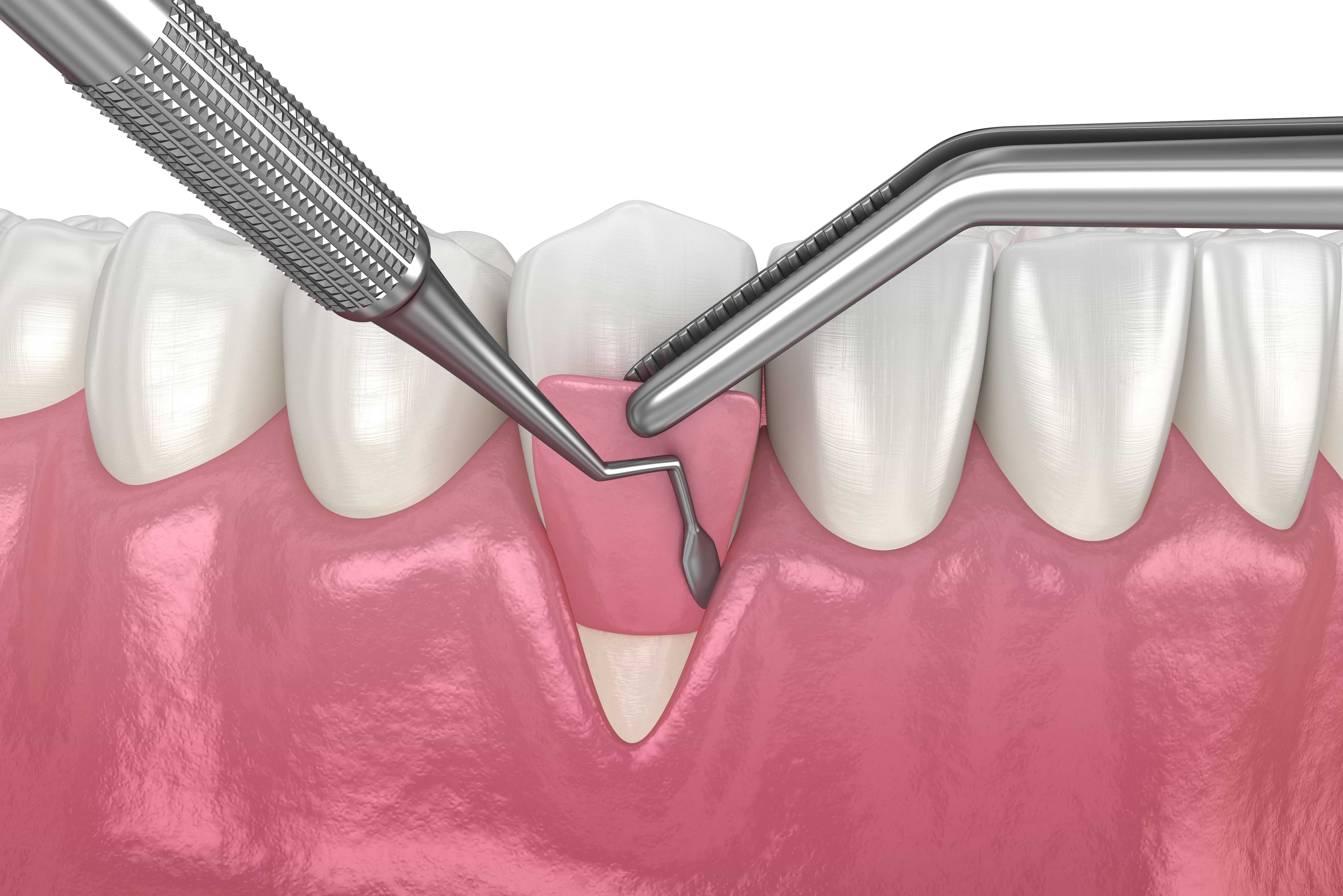 Gum Graft Explained & What to Expect