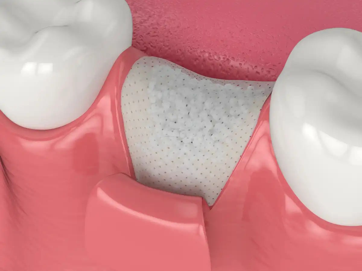 8 Signs Of Failed Dental Bone Graft