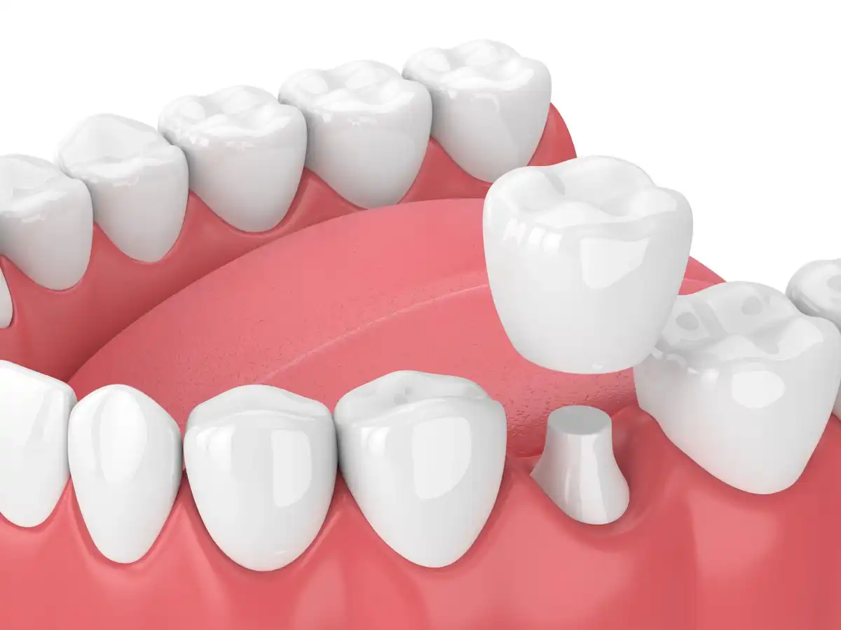 Dental Crowns: 5 Types, Procedure & Cost