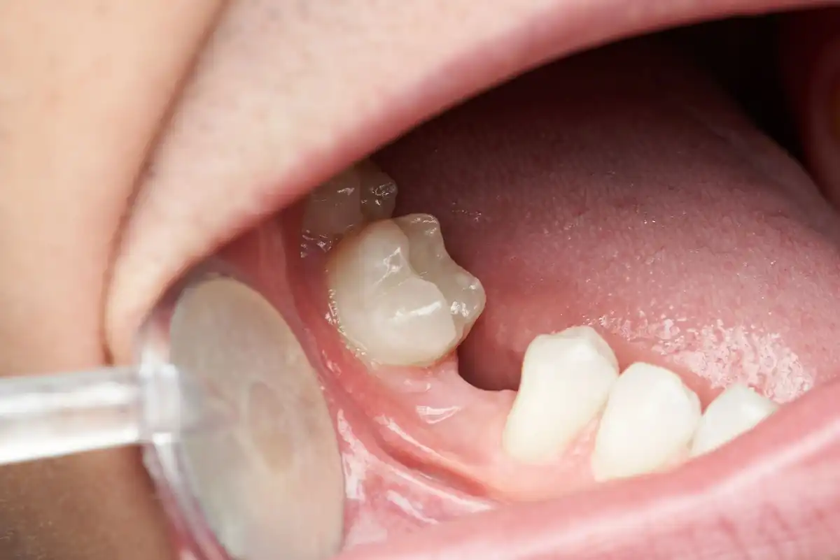 No Teeth? 6 Best Teeth Replacement Options