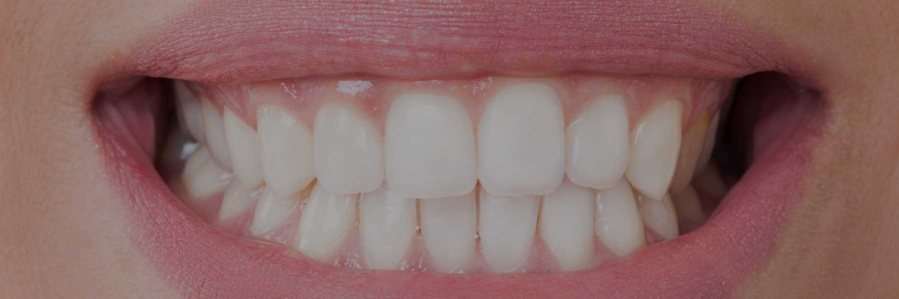 Sodium Lauryl Sulfate (SLS)