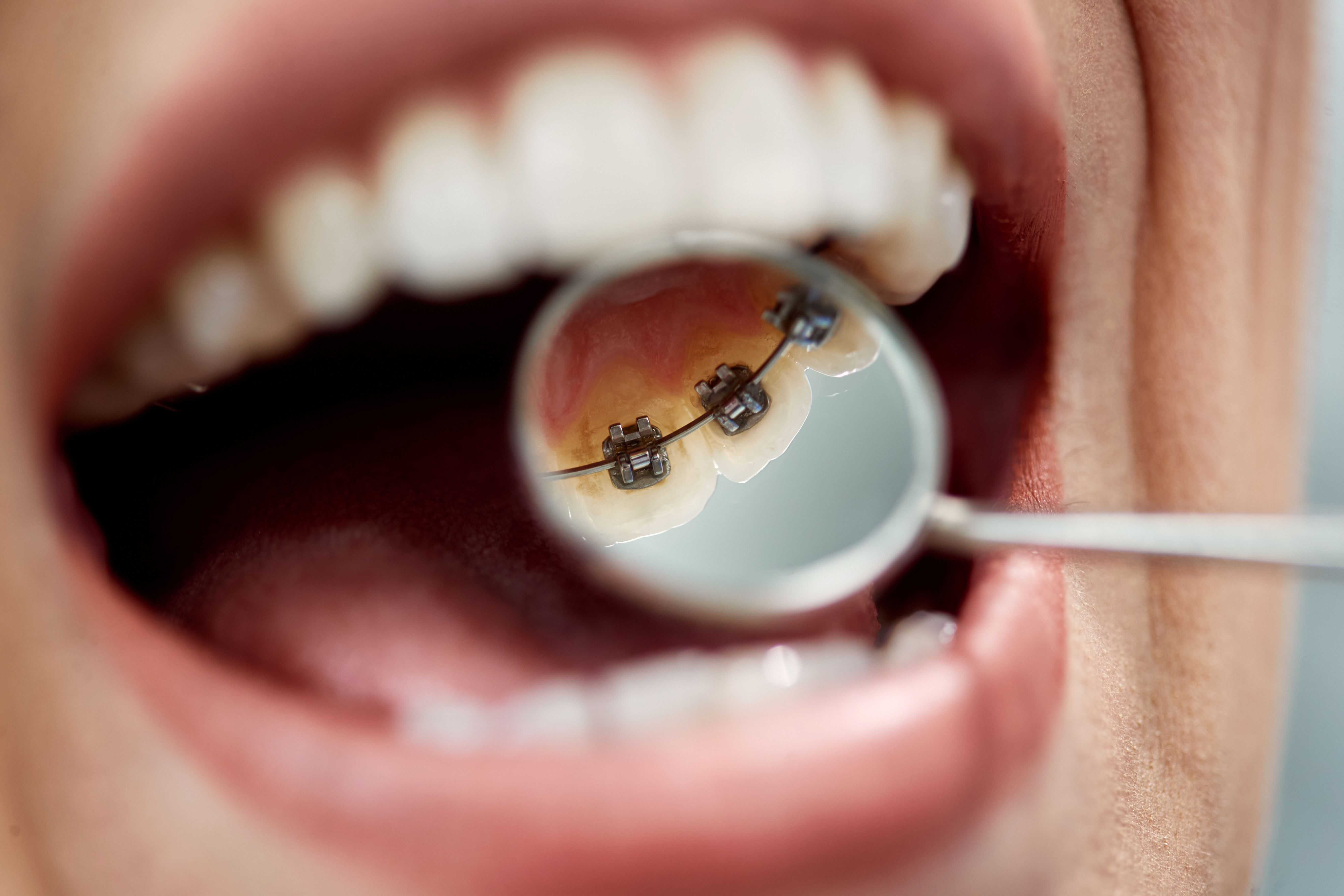 7 Things To Know About Lingual Braces: Pros, Cons & Cost