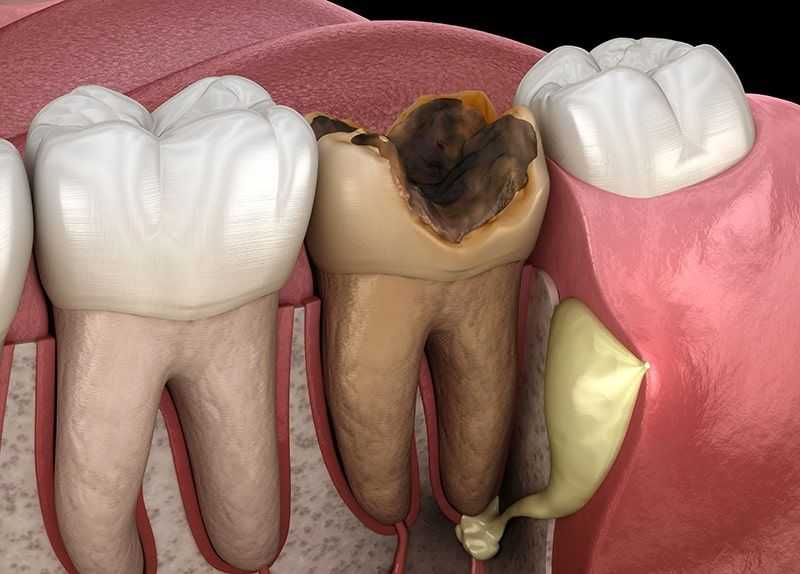 5 Signs Your Tooth Is Dead & What To Do About It