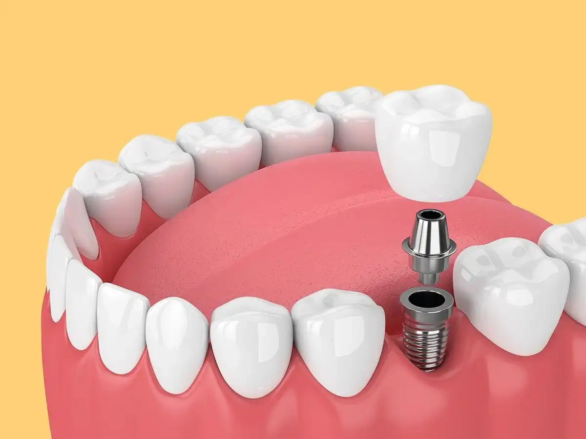 How Much Are Dental Implants? Implant Costs & What to Expect
