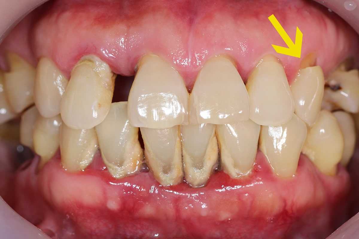 6 Reasons For Gumline Cavities & How To Fix Them